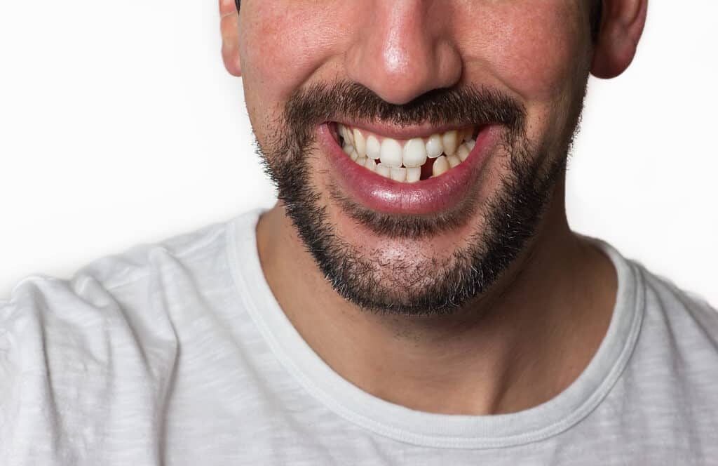 Dentist explaining to a patient what their dental options are, whether keeping the natural tooth is preferred. Close-up of a smiling man with a missing tooth, in need of restorative dental care.