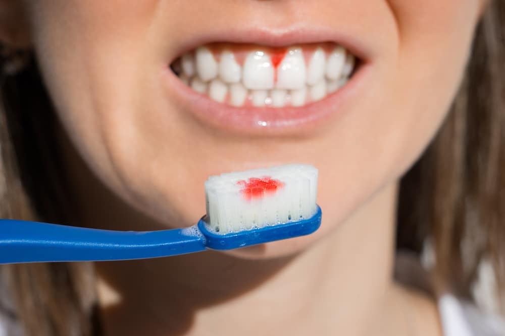 Dentist explaining to a patient what their dental options are, whether keeping the natural tooth is preferred. Close-up of a woman brushing her teeth but still struggling with gum irritation and cavities.