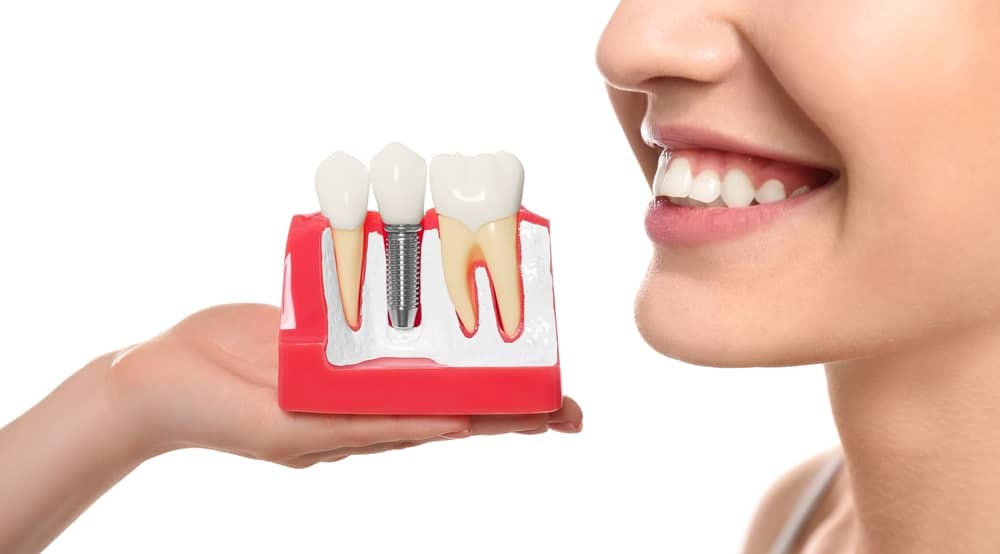 Dentist explaining to a patient what their dental options are, whether keeping the natural tooth is preferred. Close-up of a woman smiling and having a consult for her dental implants.